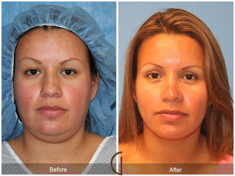 Rhinoplasty & Chin Orange County CA 1 Image