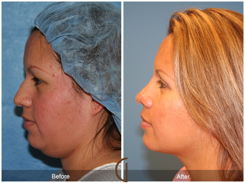 Rhinoplasty & Chin Orange County CA 1 Image