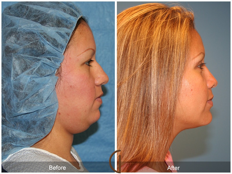 Rhinoplasty & Chin Orange County CA 1 Image