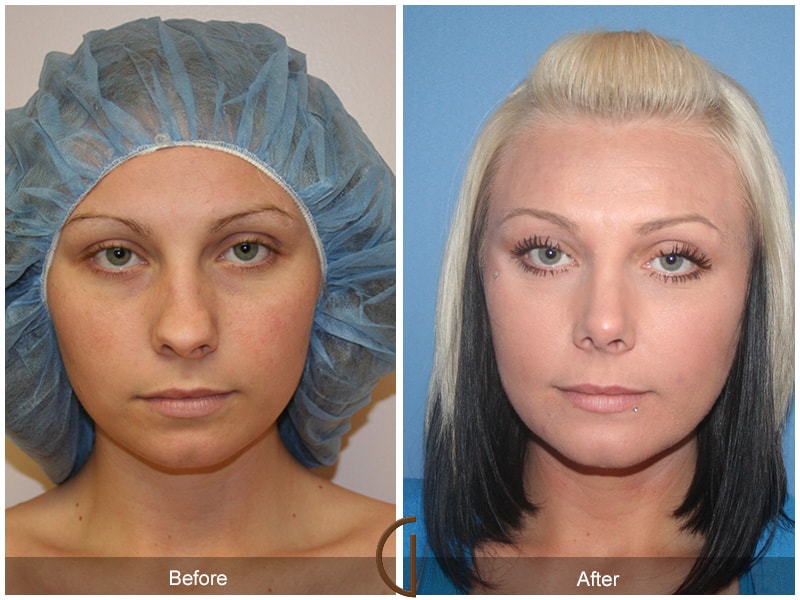 Rhinoplasty & Chin Coto de Caza CA 40 Image
