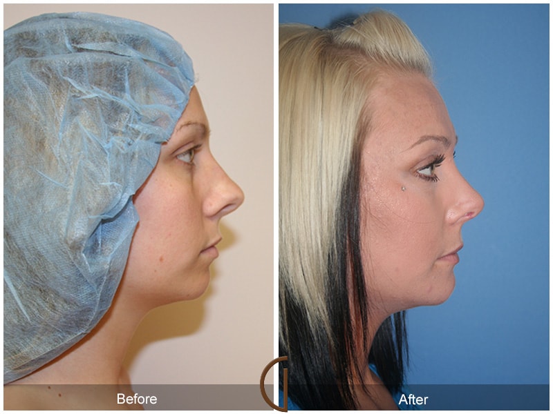 Rhinoplasty & Chin Coto de Caza CA 40 Image
