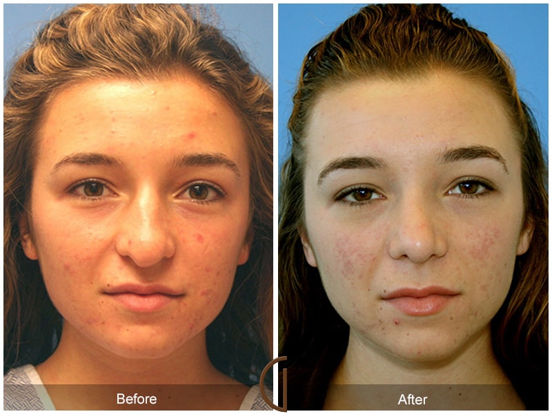 Teenage Rhinoplasty Orange County CA 20 Image