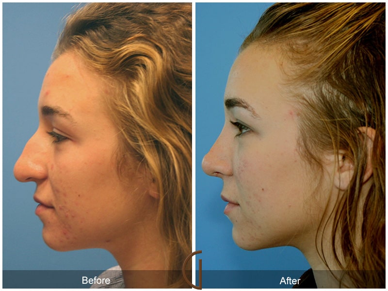 Teenage Rhinoplasty Orange County CA 20 Image