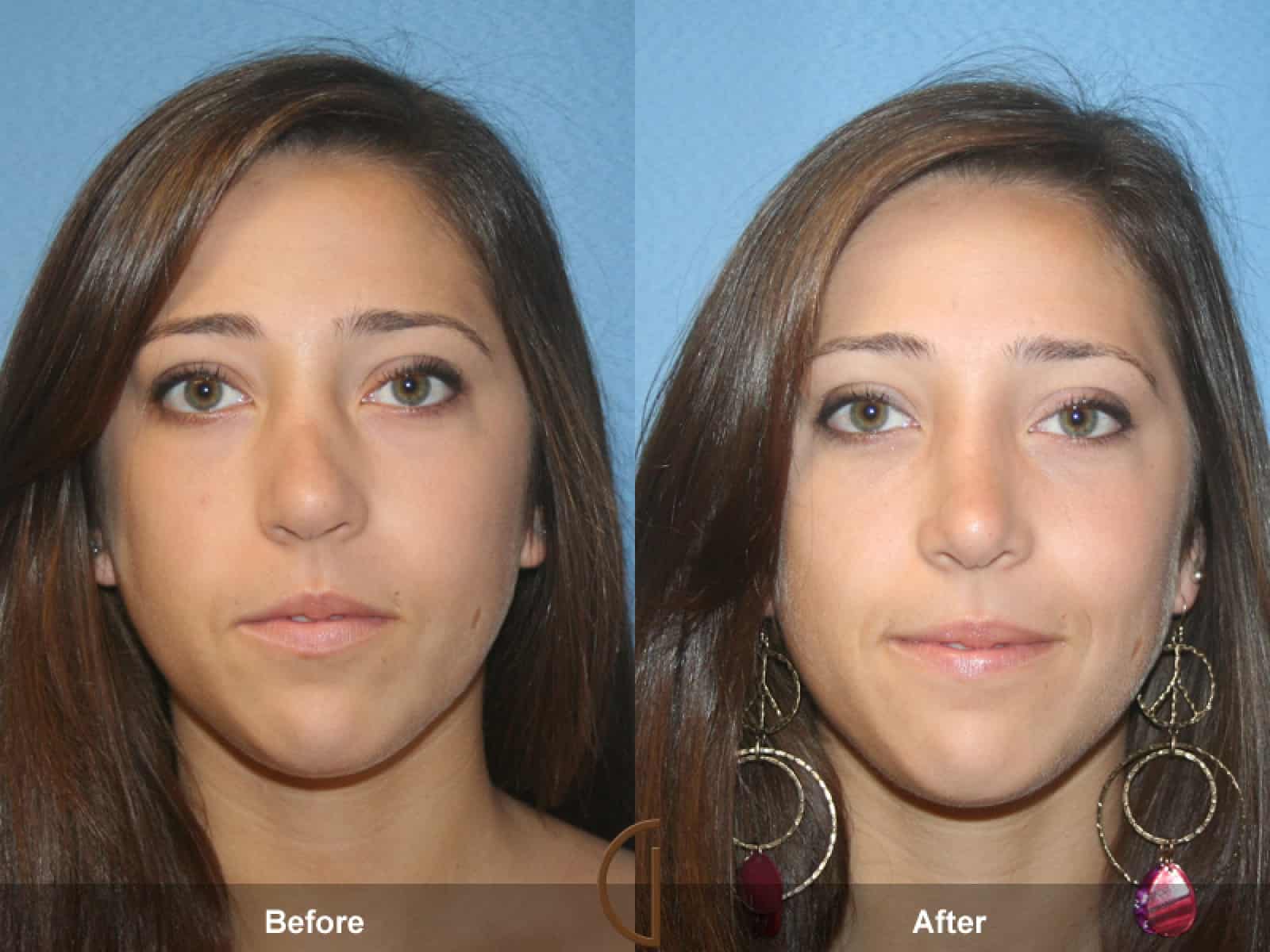 Teenage Rhinoplasty Villa Park CA 31 Image