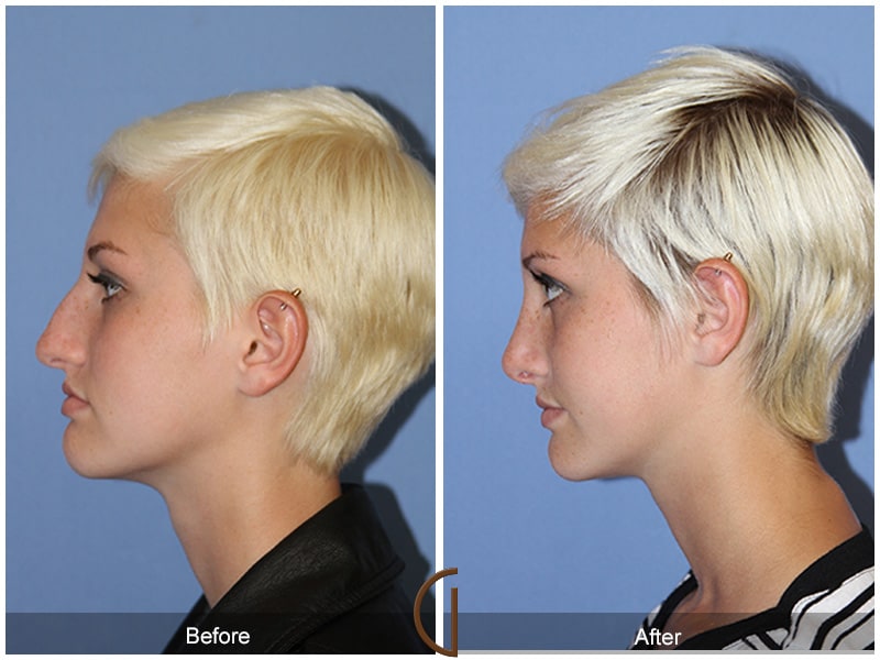 Teenage Rhinoplasty North Tustin CA 54 Image