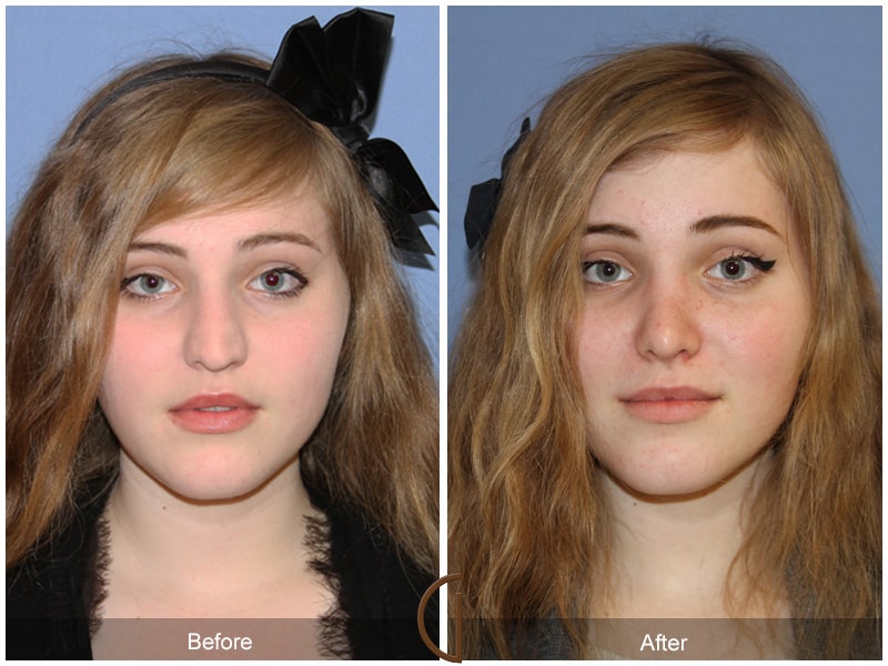 Teenage Rhinoplasty Las Flores CA 60 Image
