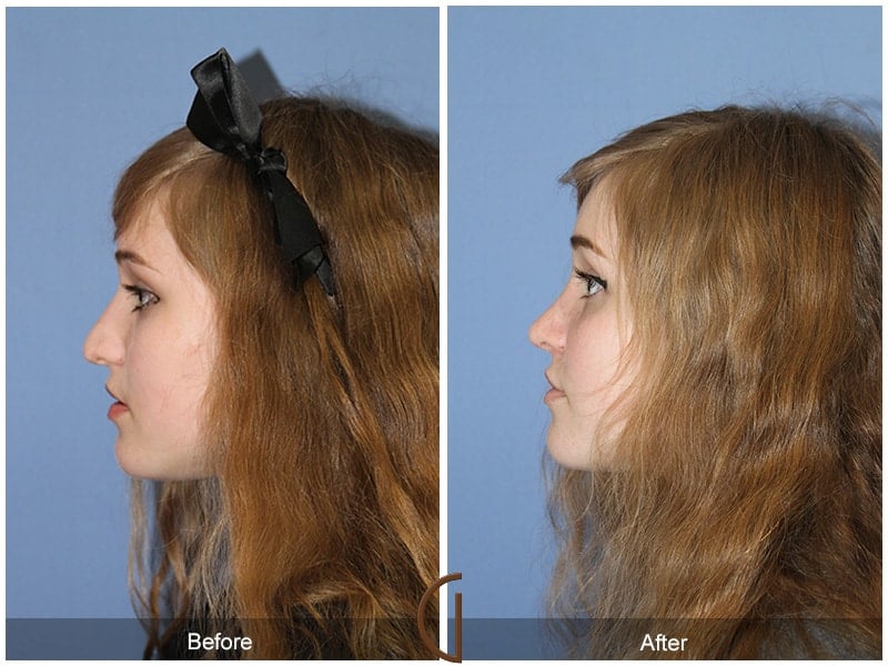 Teenage Rhinoplasty Las Flores CA 60 Image