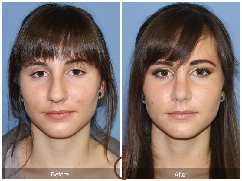 Teenage Rhinoplasty Yorba Linda CA 76 Image