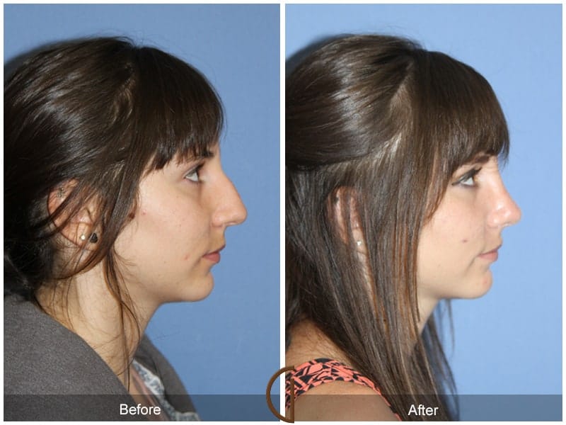 Teenage Rhinoplasty Yorba Linda CA 76 Image