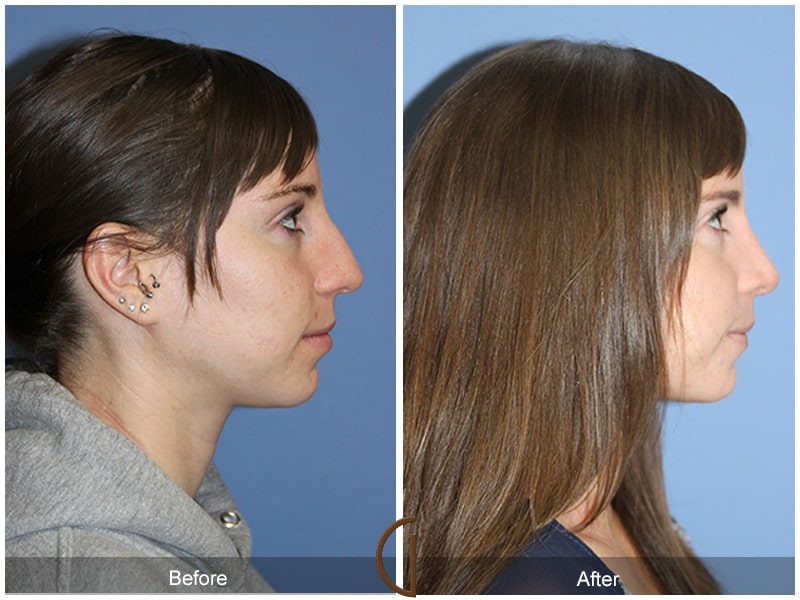 Teenage Rhinoplasty Rossmoor CA 77 Image
