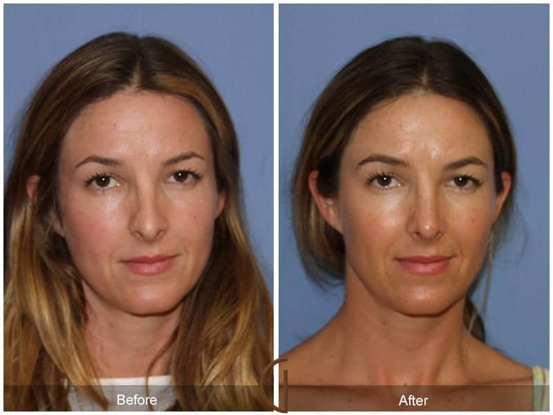 Tip Rhinoplasty Orange County CA 64 Image