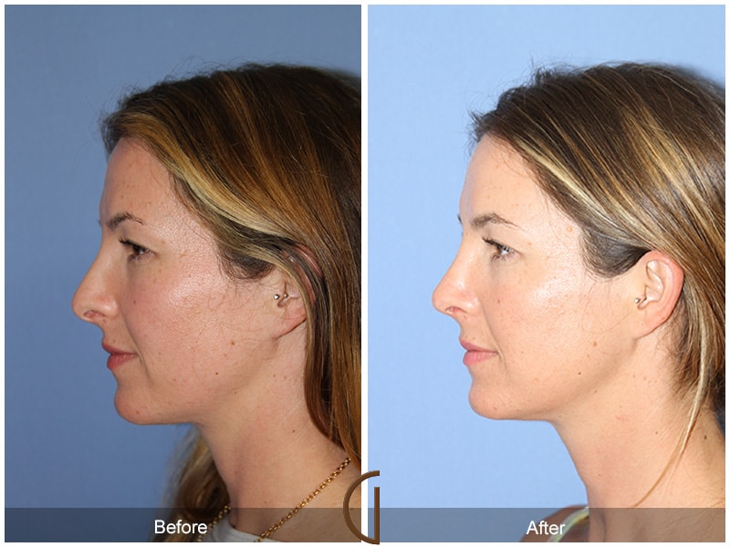 Tip Rhinoplasty Orange County CA 64 Image