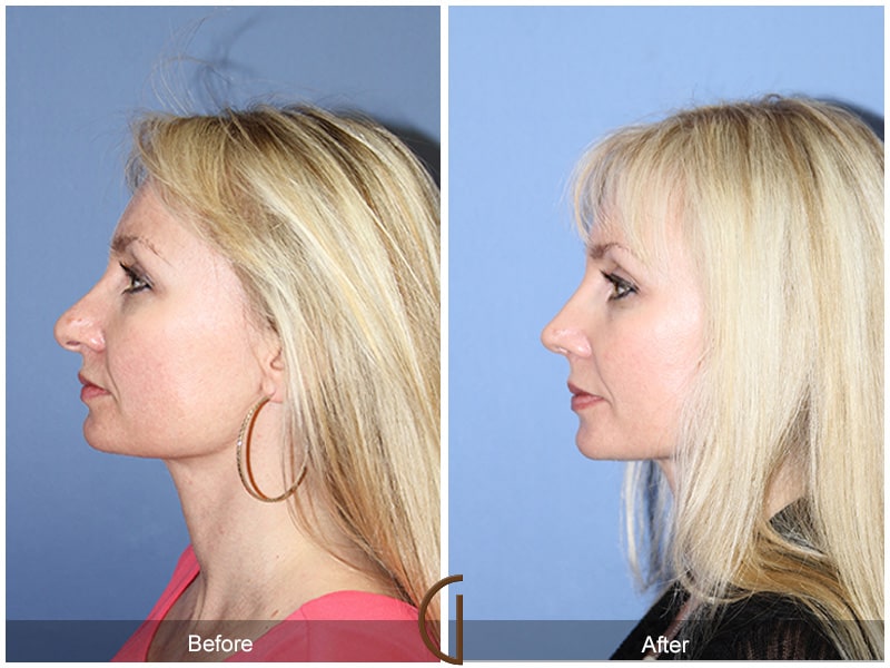 Tip Rhinoplasty Coto de Caza CA 67 Image