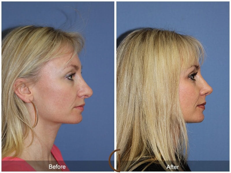 Tip Rhinoplasty Coto de Caza CA 67 Image