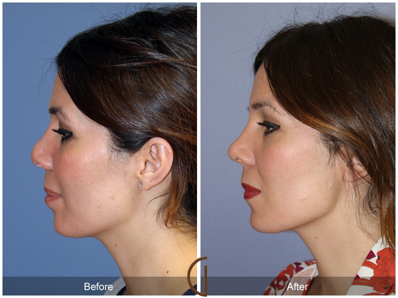 Rhinoplasty Nose Surgery Ladera Ranch CA 101 Image