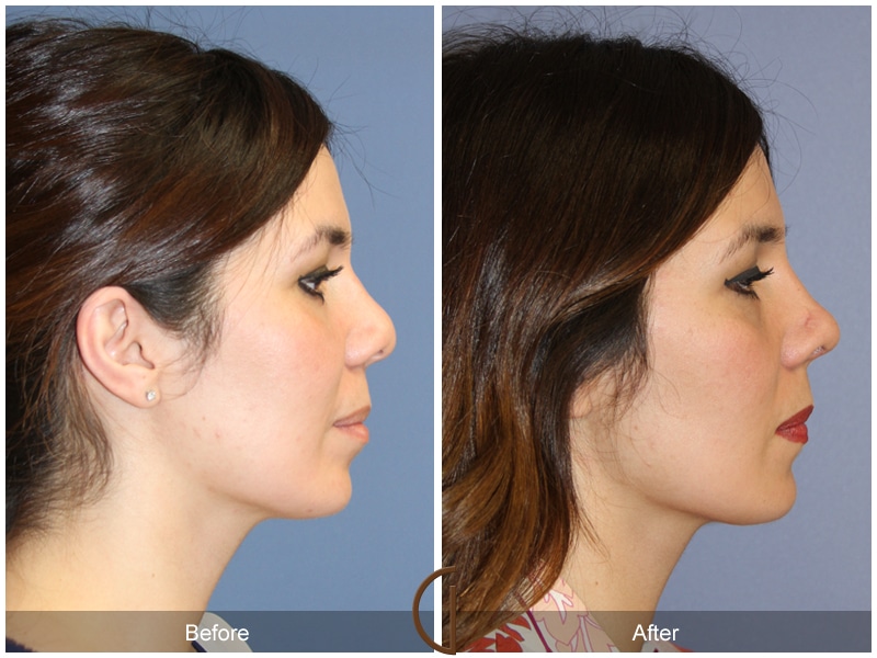 Rhinoplasty Nose Surgery Ladera Ranch CA 101 Image