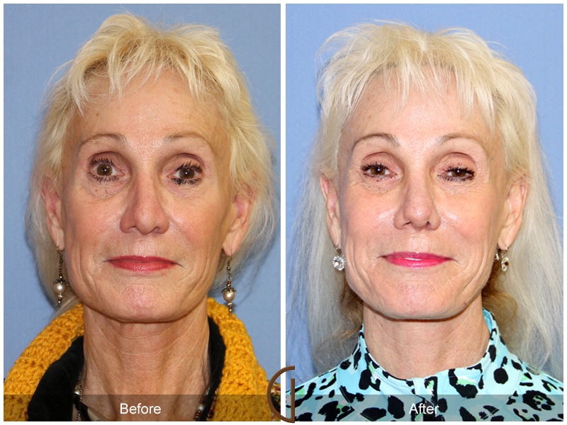 Rhinoplasty Nose Surgery North Tustin CA 102 Image