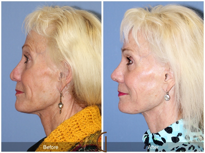 Rhinoplasty Nose Surgery North Tustin CA 102 Image
