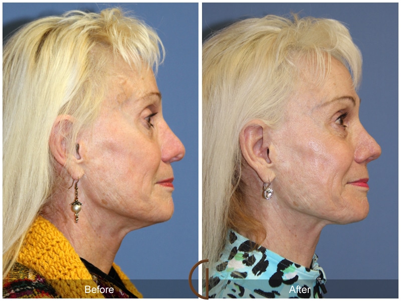Rhinoplasty Nose Surgery North Tustin CA 102 Image