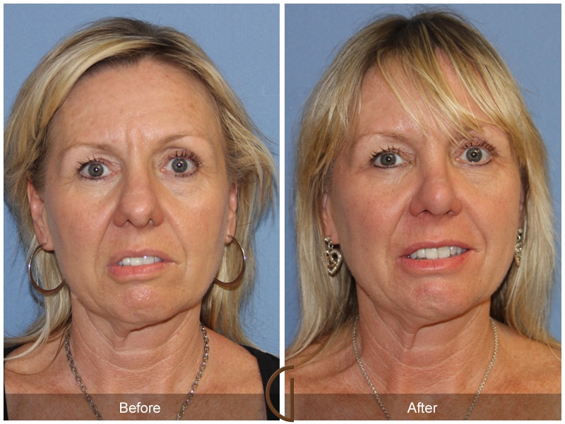 Rhinoplasty Nose Surgery Las Flores CA 103 Image