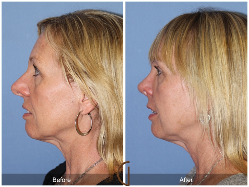 Rhinoplasty Nose Surgery Las Flores CA 103 Image