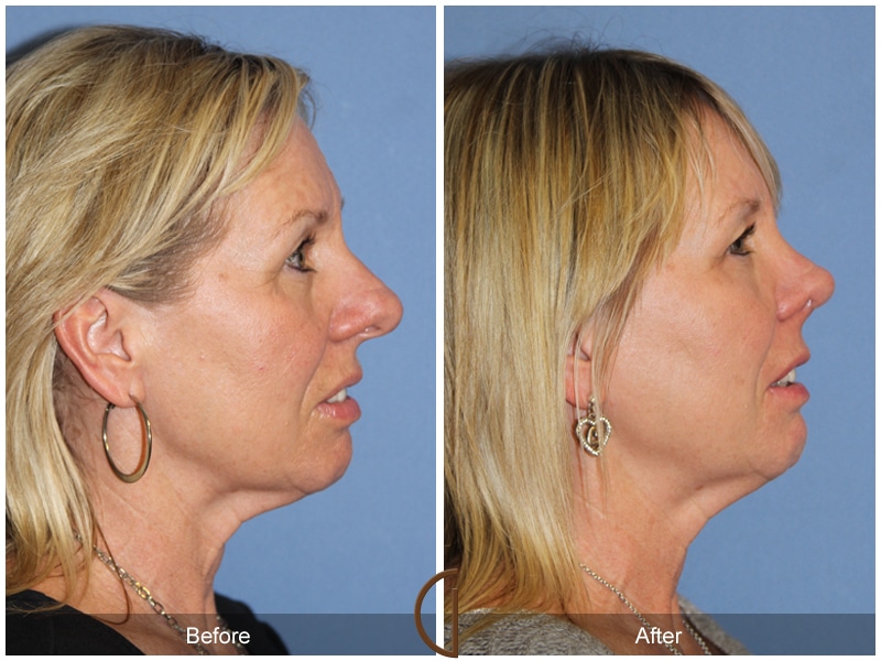 Rhinoplasty Nose Surgery Las Flores CA 103 Image