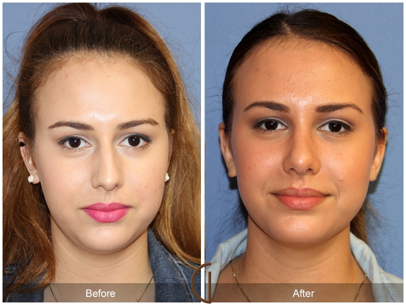Rhinoplasty Nose Surgery Yorba Linda CA 104 Image
