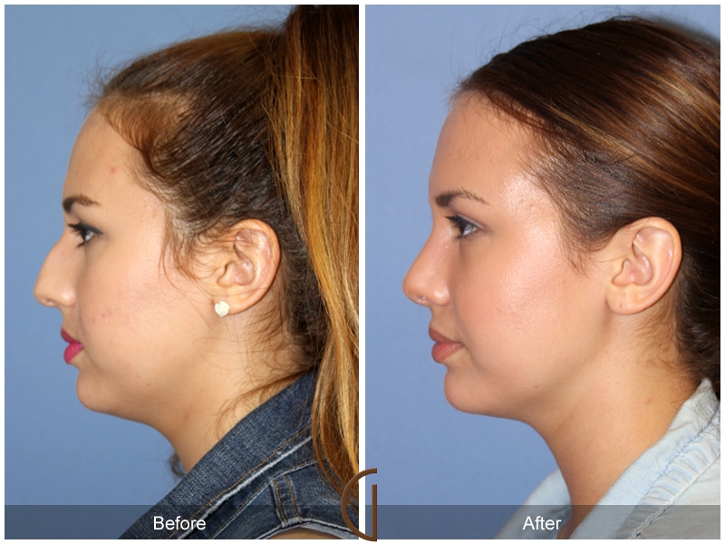 Rhinoplasty Nose Surgery Yorba Linda CA 104 Image