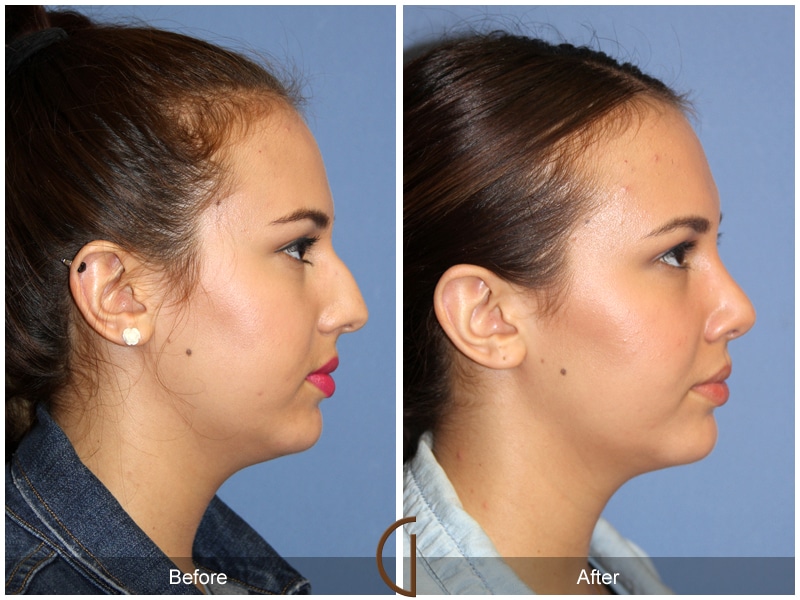 Rhinoplasty Nose Surgery Yorba Linda CA 104 Image