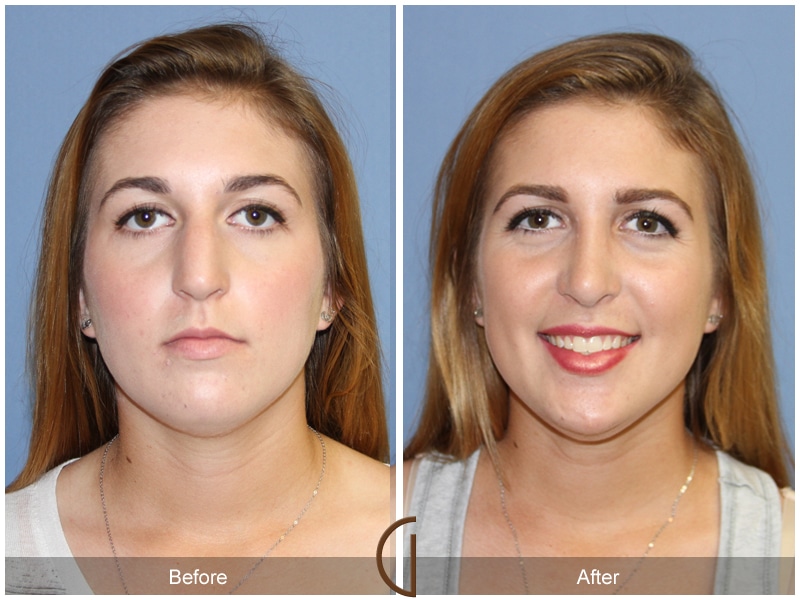 Rhinoplasty Nose Surgery Rossmoor CA 105 Image