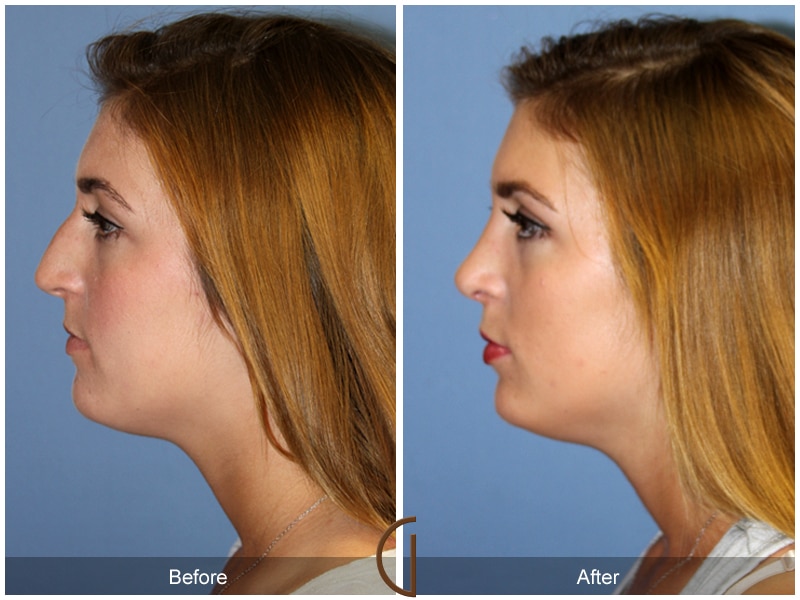 Rhinoplasty Nose Surgery Rossmoor CA 105 Image