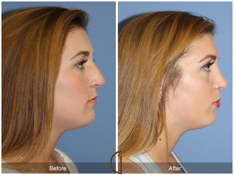 Rhinoplasty Nose Surgery Rossmoor CA 105 Image