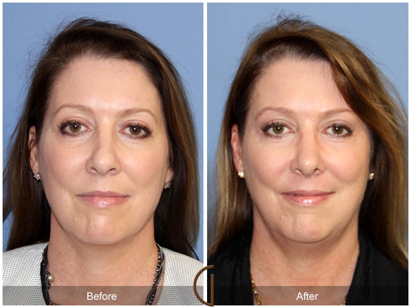Rhinoplasty Nose Surgery Newport Beach CA 106 Image