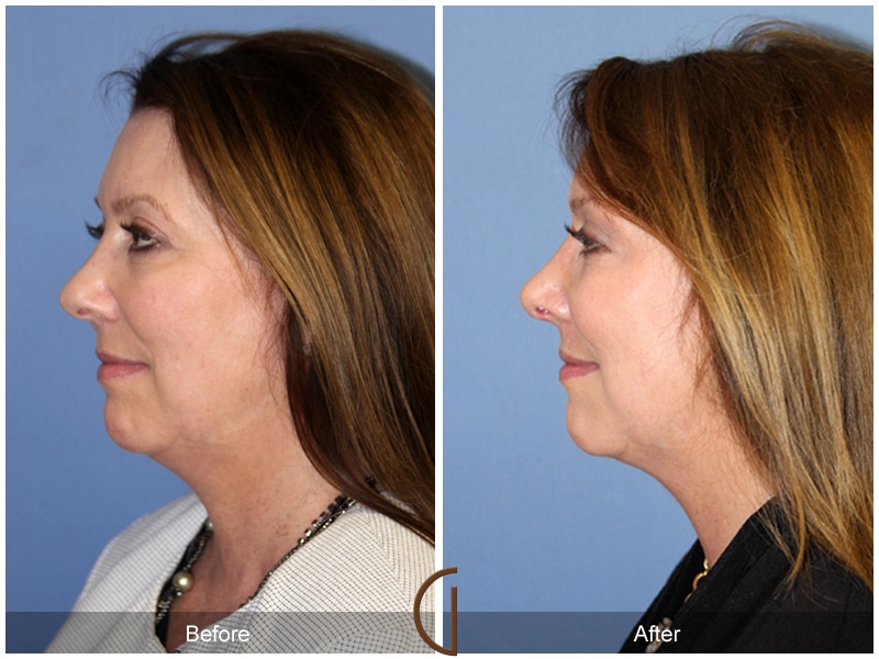 Rhinoplasty Nose Surgery Newport Beach CA 106 Image