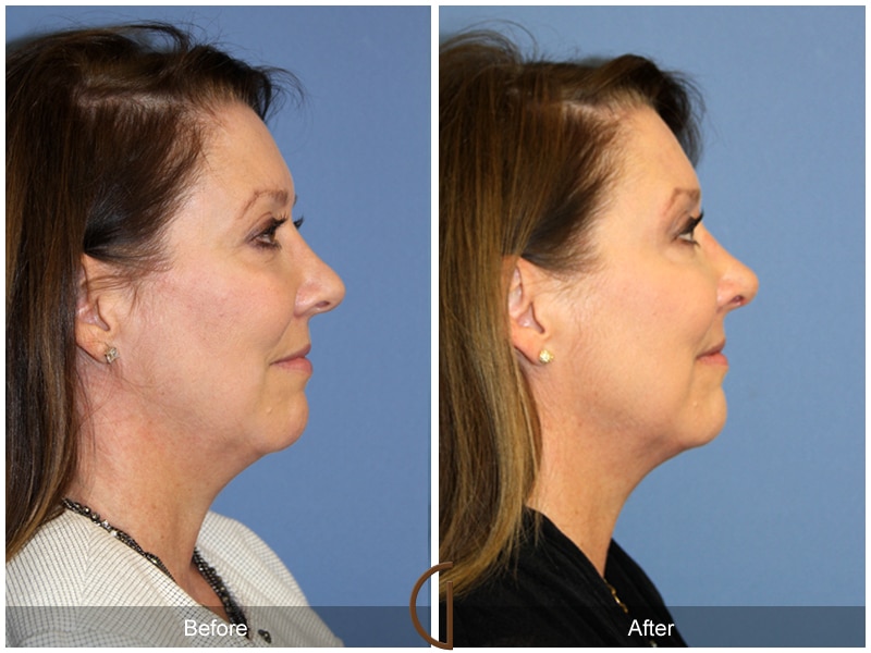 Rhinoplasty Nose Surgery Newport Beach CA 106 Image