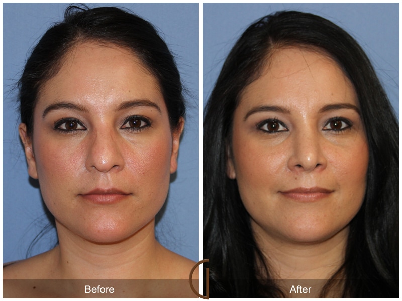 Rhinoplasty Nose Surgery Rancho Santa Margarita CA 107 Image