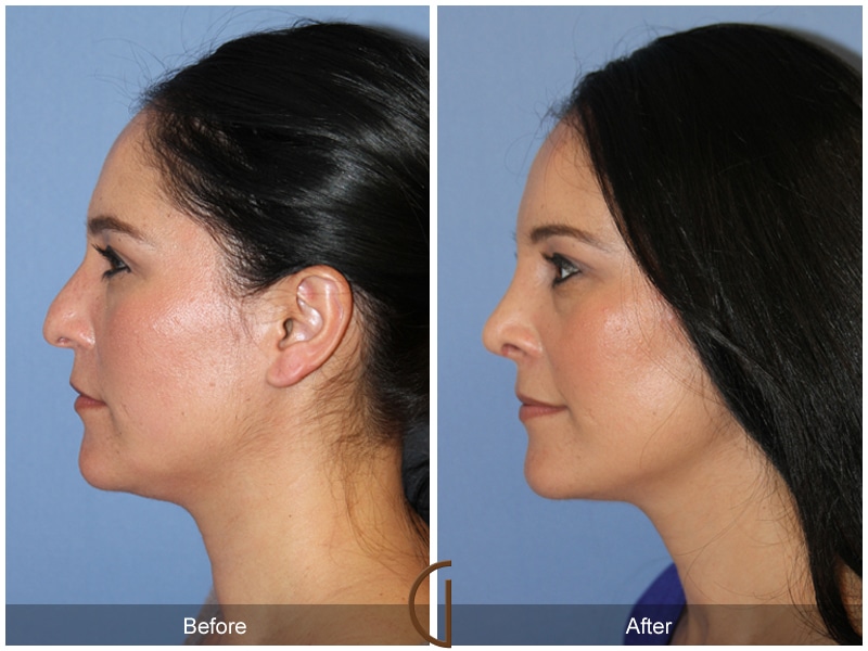Rhinoplasty Nose Surgery Rancho Santa Margarita CA 107 Image
