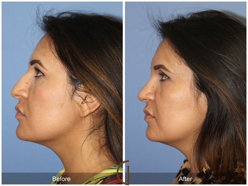 Rhinoplasty Nose Surgery Aliso Viejo CA 108 Image