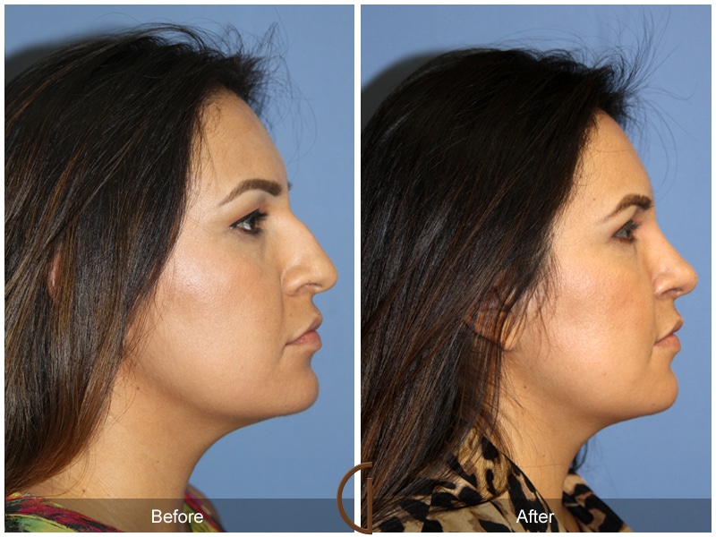 Rhinoplasty Nose Surgery Aliso Viejo CA 108 Image