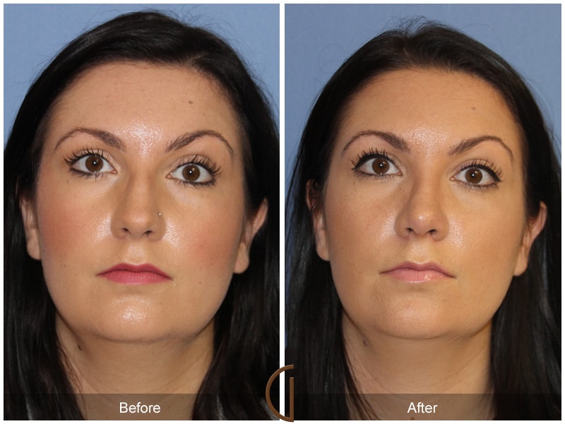 Rhinoplasty Nose Surgery Laguna Niguel CA 109 Image