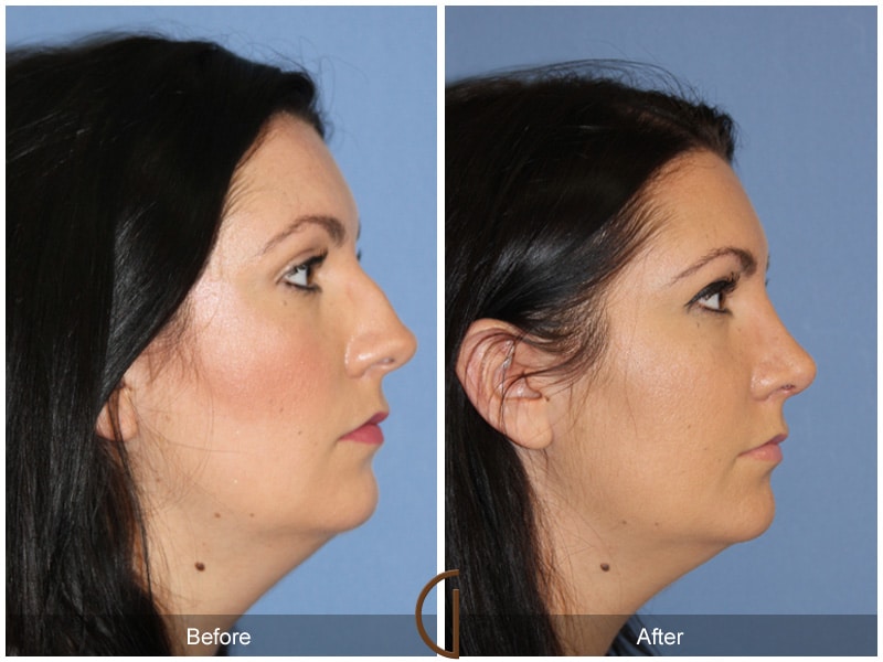 Rhinoplasty Nose Surgery Laguna Niguel CA 109 Image
