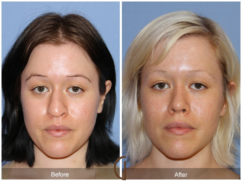 Rhinoplasty Nose Surgery Laguna Beach CA 110 Image