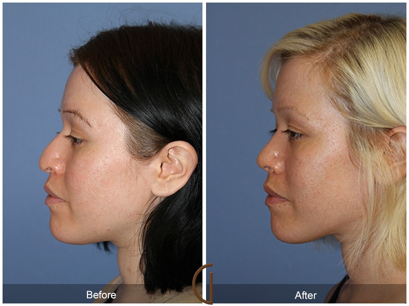 Rhinoplasty Nose Surgery Laguna Beach CA 110 Image