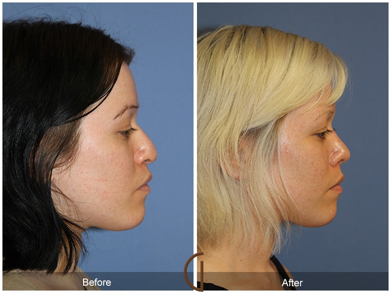 Rhinoplasty Nose Surgery Laguna Beach CA 110 Image