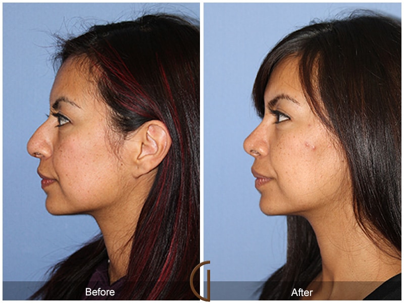 Rhinoplasty Nose Surgery Lake Forest CA 111 Image