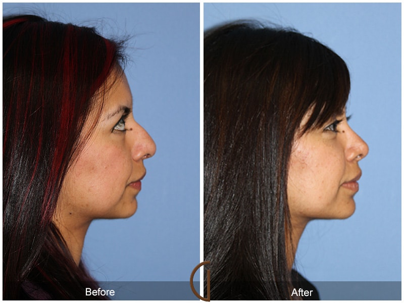 Rhinoplasty Nose Surgery Lake Forest CA 111 Image