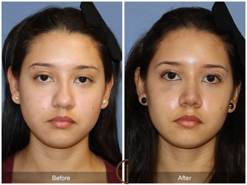 Rhinoplasty Nose Surgery Irvine CA 112 Image