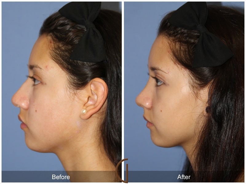 Rhinoplasty Nose Surgery Irvine CA 112 Image