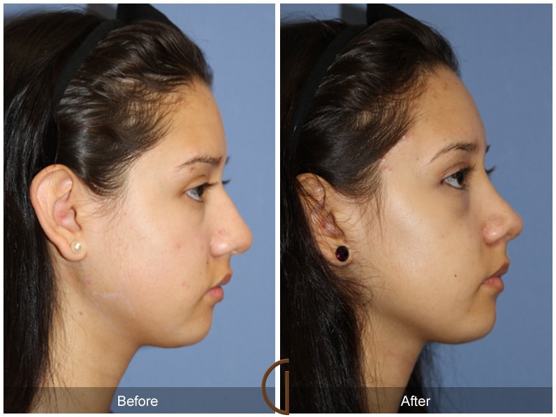 Rhinoplasty Nose Surgery Irvine CA 112 Image