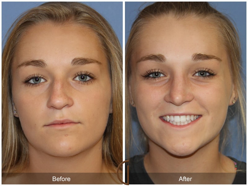 Rhinoplasty Nose Surgery San Clemente CA 113 Image